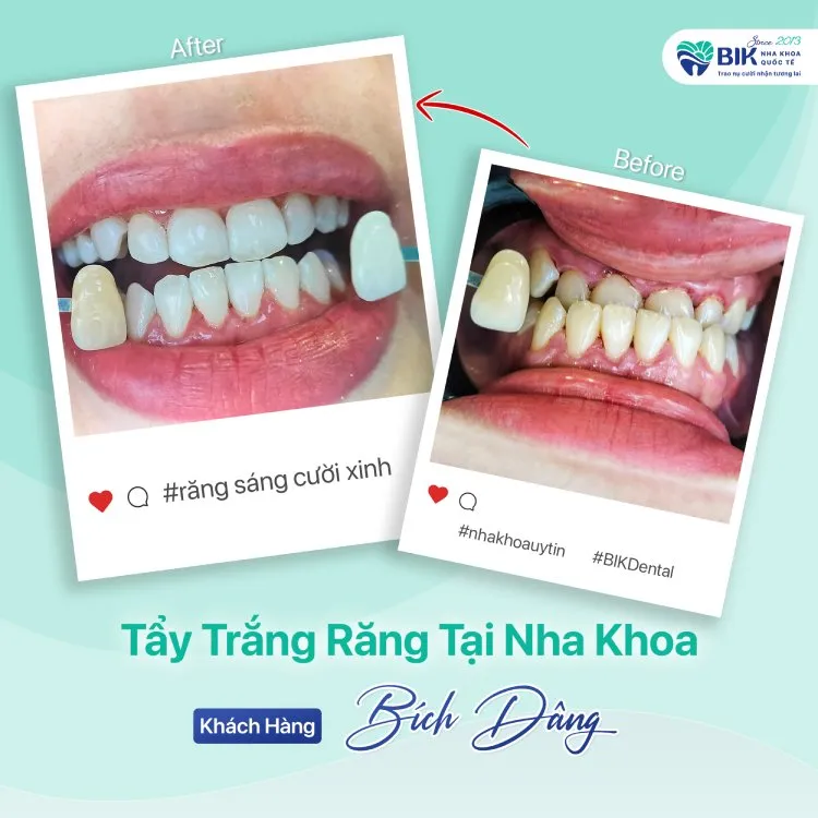 khach-hang-tay-trang-rang-bich-dang Kết quả ấn tượng mang lại sự tự tin tuyệt đối cho khách hàng