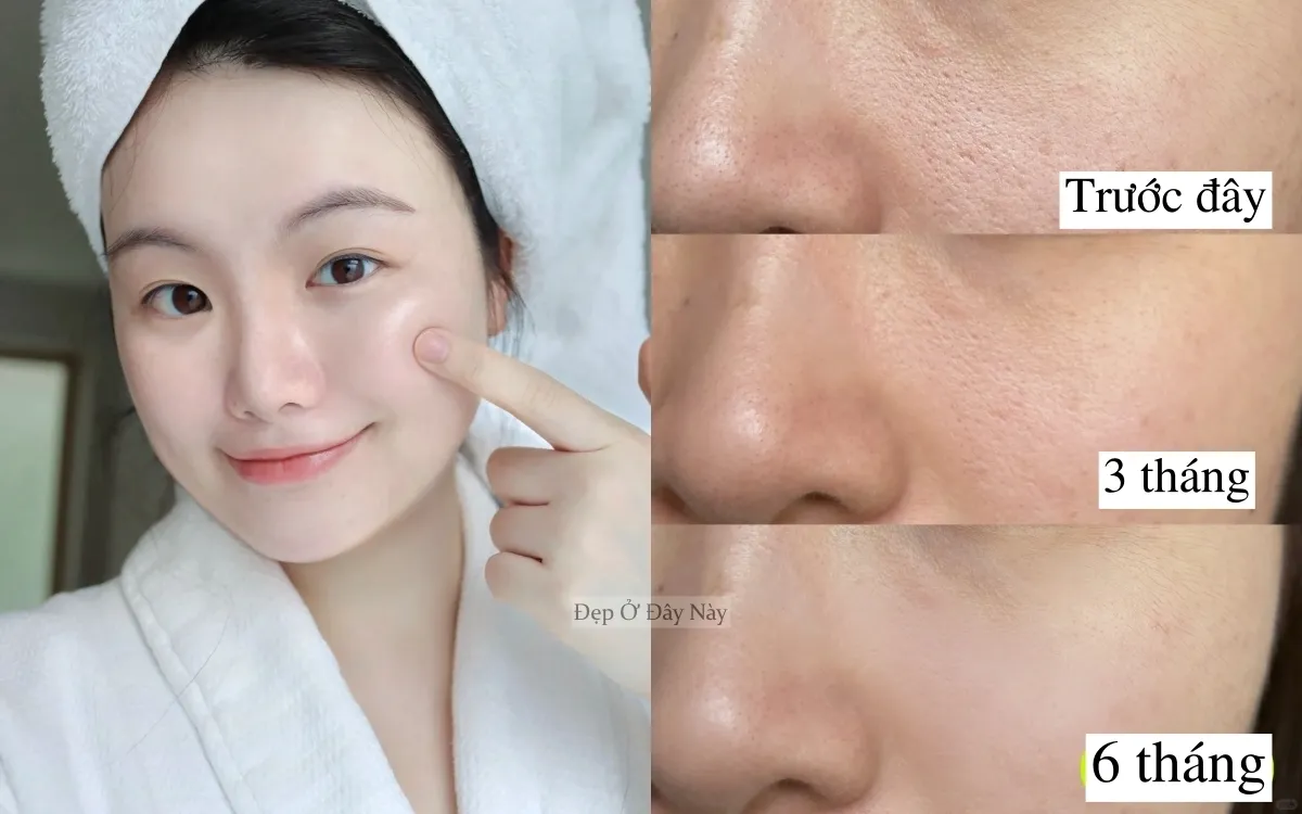 Lỗ chân lông thông thoáng là chìa khóa để ngăn ngừa mụn trứng cá và các vấn đề về da
