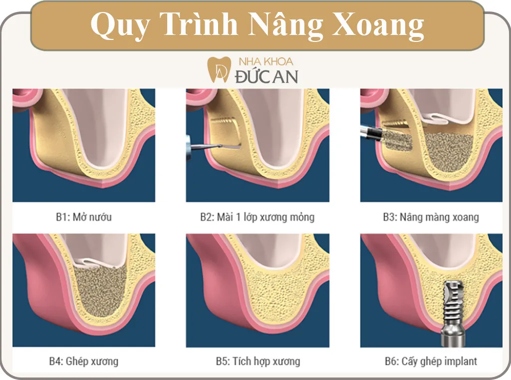 quy-trinh-nang-xoang-ho-copy Mô phỏng kỹ thuật ghép xương hỗ trợ cấy ghép Implant cho người bị tiêu xương