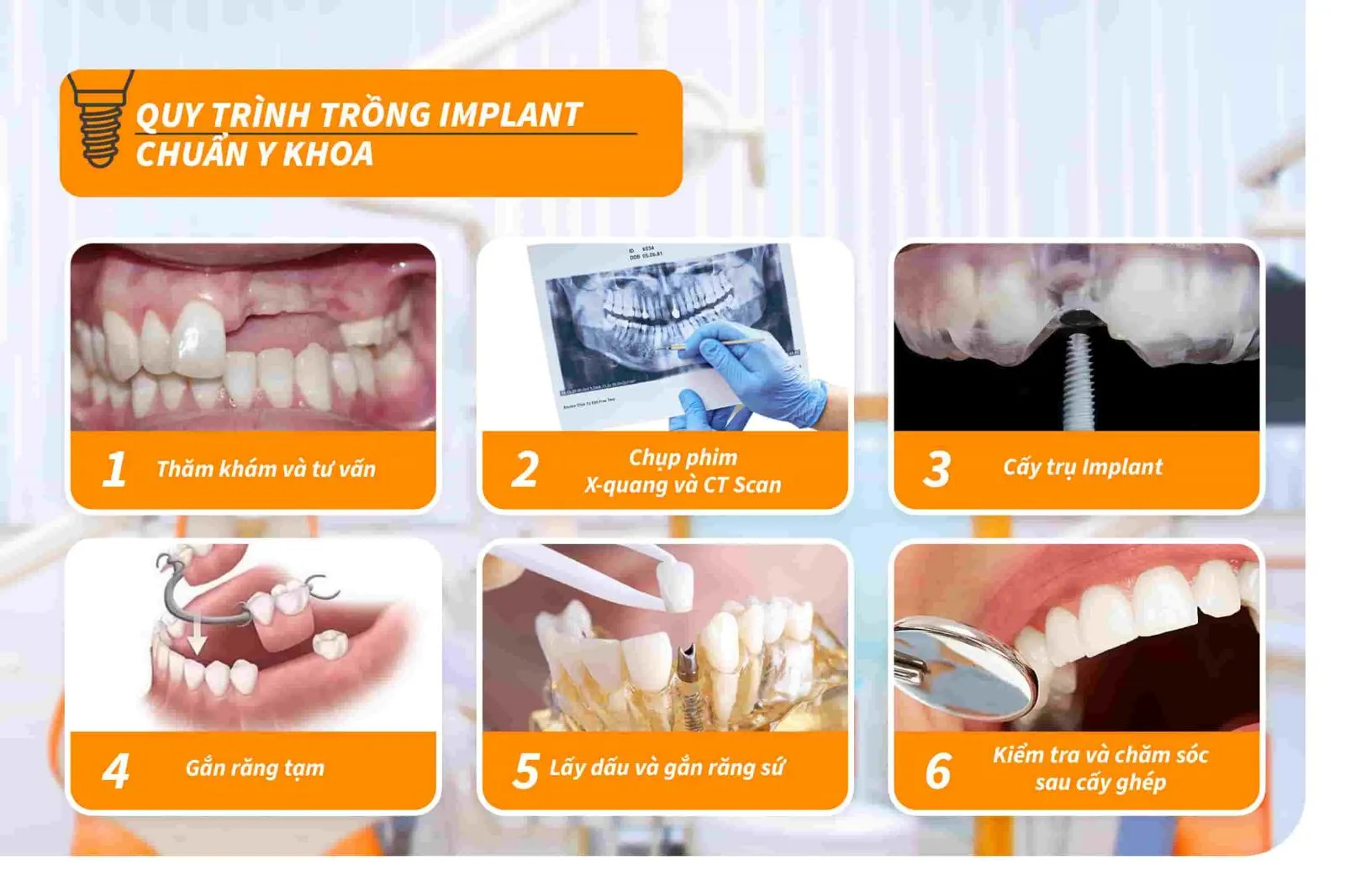 Cấy ghép Implant là một trong những dịch vụ thế mạnh hàng đầu tại Nha khoa Lê Hưng